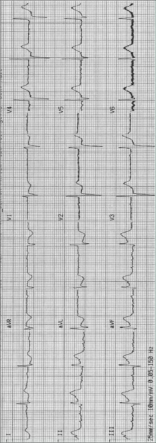 Answer ECG # 1 Leads II, III, avf all have ST elevation, these are contiguous inferior leads Leads I, avl, V2, V3 and V4 all have ST depression signifying reciprocal