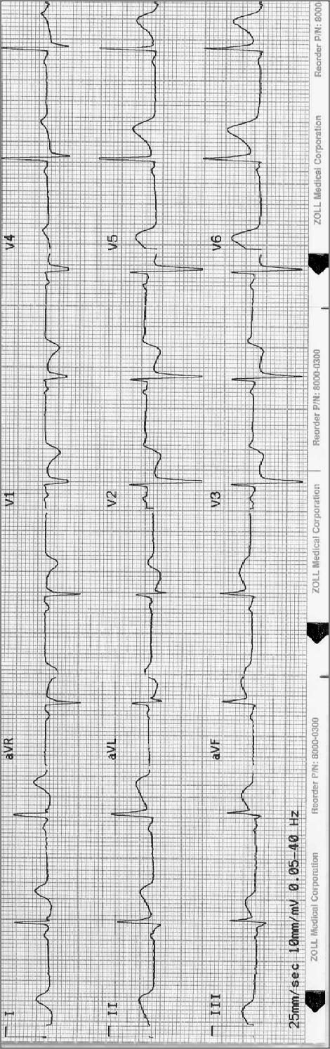 Answer ECG # 5 ST elevation in leads II, III, avf and V6 Reciprocal changes in leads V2, V3 and V4 II, III and avf are inferior leads, V6 is a lateral lead and ST elevation must be