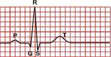 PR Interval Begins at the end of the P wave Ends at the beginning of the QRS When determining the isoelectric or baseline find the PR interval of 2 consecutive complexes,