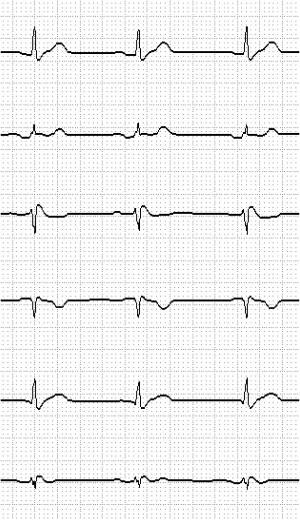Takahashi N ST elevation by ischemia in rugada syndrome Case Report 35-year-old man who habitually smoked had undergone diagnostic catheterization when he was 32 years old, due to chest pain and