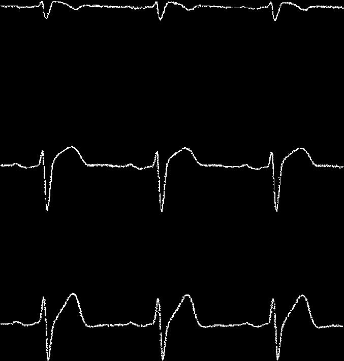 Figure 2 Electrocardiographic (ECG) changes by intravenous injection of 400 mg procainamide.. ECG (leads ) before procainamide.. ECG (leads ) after procainamide.