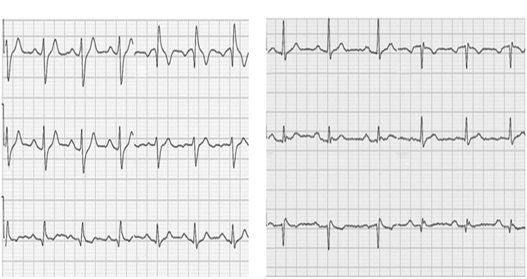 Brugada Syndrome and Early Repolarisation segment, confers the highest arrhythmic risk.