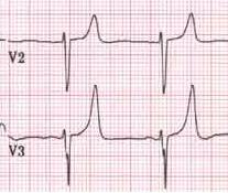 T wave Abnormalities Peaked hyperkalaemia or normal young man