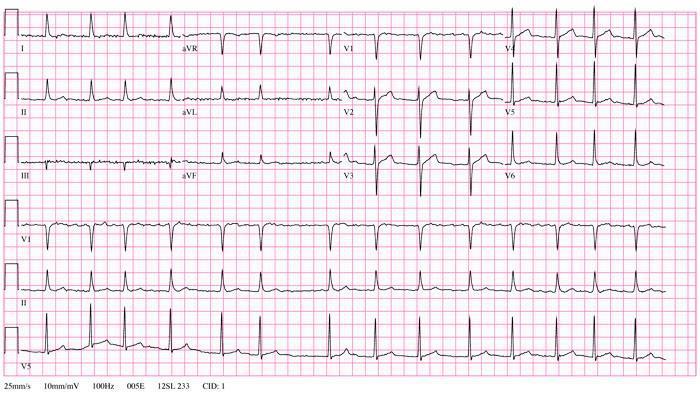 Past-Years Mini-OSCE Question: A 68 year old male presents with hx of frequent palpitations. What is your diagnosis?
