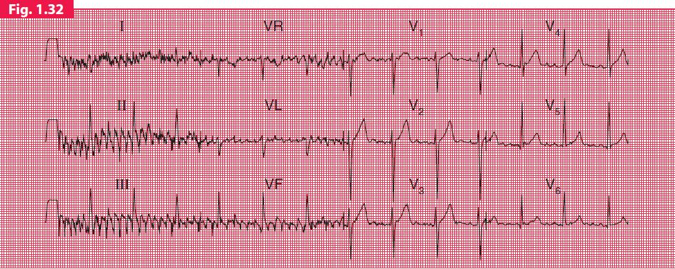 progression R wave Ischemia S wave in V6?