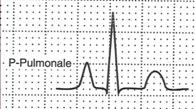 The Abnormalities of the waves, complexes and intervals: Absence P Pulmonale: Pointy; >2.