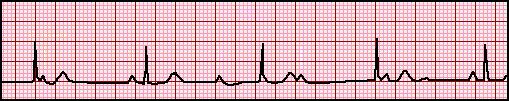 - As the PR interval prolongs, the RR interval actually shortens 2 nd degree Heart block (Mobitz 2): Constant PR