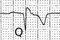 QRS complex Abnormalities Generally, if QRS > 0.