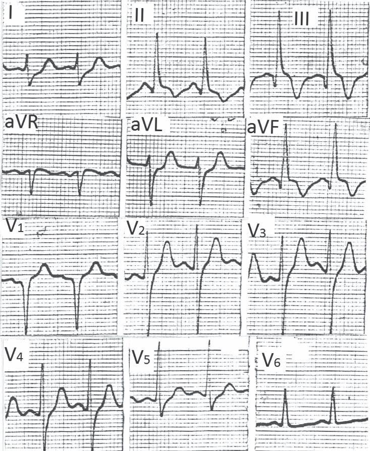 progressive delay in conduction rather than block. Only patients with sudden appearance of ECG findings during an acute cardiac illness can be considered to have a fascicular block.