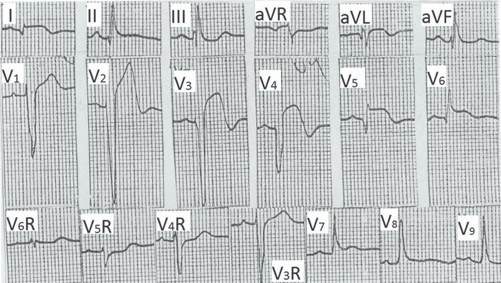 Acute myocardial infarction. ST segment elevation and sequential changes help in diagnosis of acute myocardial infarction. Figure 8.