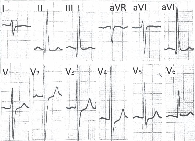 mentioned conditions are not associated with tall R in II, III, avf. QRS duration of more than 0.10 sec (Figure 13 ) It suggests additional intra-ventricular conduction delay. Figure 12.