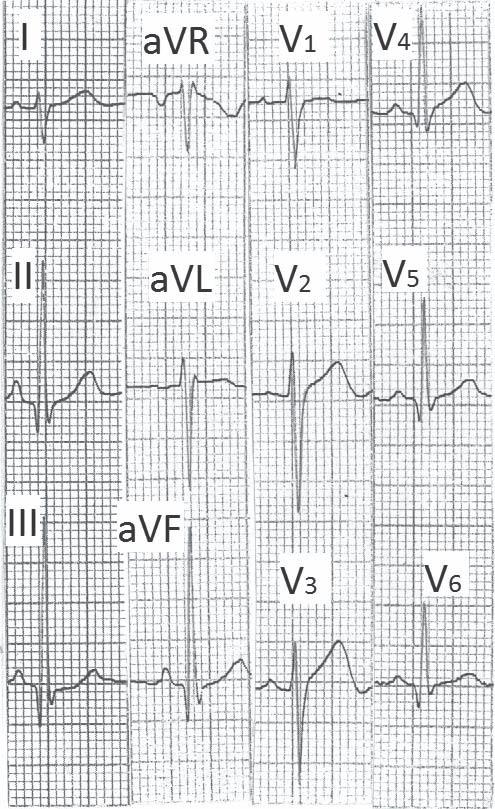 Posterior chest leads(v7 to V9) and right sided chest leads (V3R to V6R) also show infarction pattern. Changes in T wave Deep symmetrical T wave inversions are abnormal.
