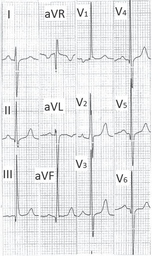 ECG OF THE MONTH Figure 17. Electrocardiogram from a patient of emphysema mimicking left posterior fascicular block. QRS shows low voltage.