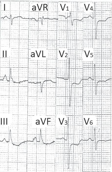 (b) Vertical heart (Figure 17) Eg. - slender body - emphysema- QRS voltage is low as opposed to LPH. (c) Chest deformities. (d) Extensive lateral infarction.