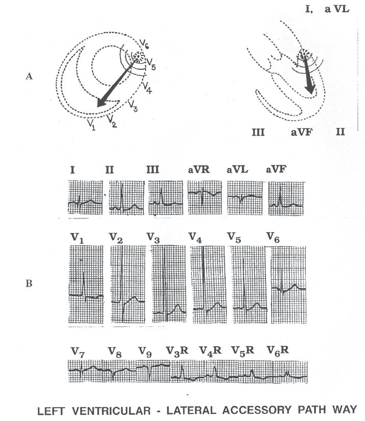 Electrocardiogram showing right ventricular hypertrophy mimicking left posterior fascicular block. Figure 18.