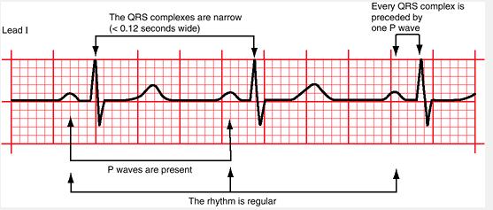 Rhythm Normal sinus Rhythm( originated from SA) The P waves in leads I and II