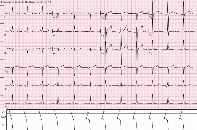 Wandering Pacemaker at least 3 different P wave