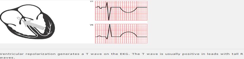 T wave The normal T wave is usually in the same direction as the QRS except in the right precordial leads(