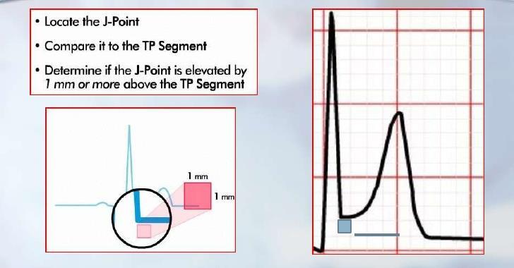 12 Lead ECG Analysis Observe for ST elevation and T wave inversion in Lead Sets Anterior Lead Set V3, V4