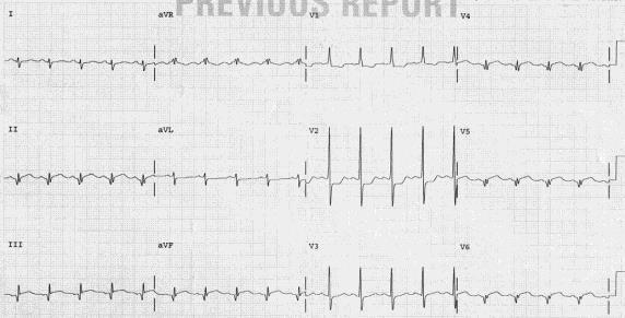 MI with Q waves Case Study 1 Mr P, a 44-year-old man, came to the emergency