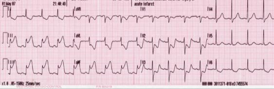 BP 136/79, O2 sat 92% RA A 12-lead ECG is below. What should you do next?