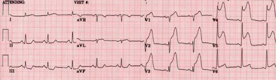 chest pain accompanied by shortness of breath, nausea, and diaphoresis that had