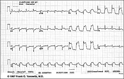 Case Study 3 Mr T was a 52-year-old man with midsternal heaviness and tightness that radiated down both arms and into his neck for last 20 minutes VS 159/98, HR 100, RR 24 A 12-lead ECG is below Case