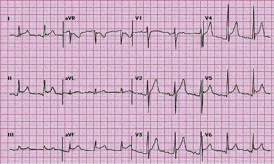12 LEAD ECG CASE STUDIES Lisa Riggs MSN, RN, ACNS-BC, CCRN-K CASE #1 31 y/o male is a direct admit from the physician s office with c/o chest pain and SOA WHAT ELSE WOULD YOU ASSESS?