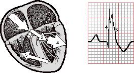 SVT CHARACTERISTICS ABERRANT CONDUCTION Regular rhythm Rate greater than 150 bpm Unable to distinguish P waves Unable to measure PR interval QRS 0.