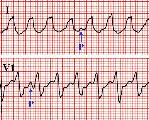 distortion within single cycles Check for inverted P waves in II, III, avf VT WITH AV DISSOCIATION PHYSICAL SIGNS WITH AV