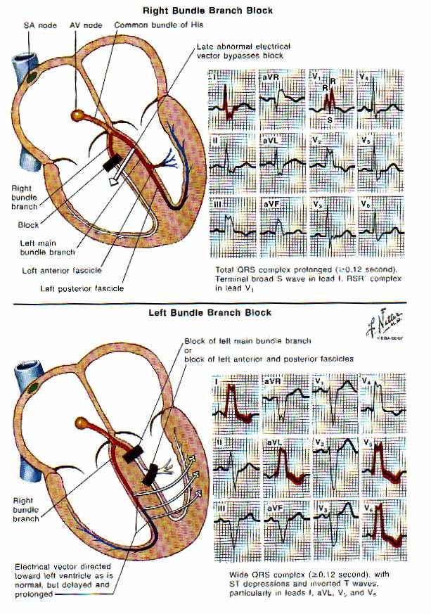 Bundle Branch Blocks QRS Duration >120ms RBBB Look in V1 RSR in V1 Broad S in I Secondary ST-T changes in V1-V2 LBBB Look in lateral leads Broad QRS in lateral leads