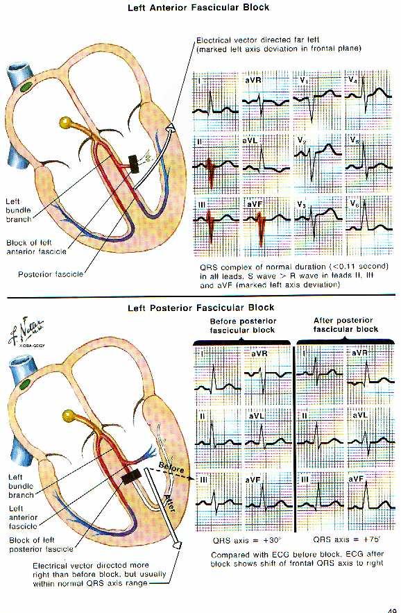 Fascicular Blocks QRS Duration <120ms LAHB (LAFB) Severe LAD without explanation Deep S waves in II, III, avf Frontal Axis <-45 to -60 degrees Positive in I, Negative in avf Not explained by LBBB,
