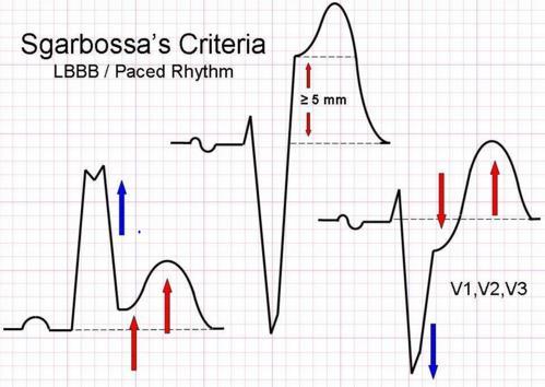 Sgarbosa s Criteria Concordant ST elevation > 1mm in leads with a positive QRS complex (score 5) Concordant ST depression > 1 mm in V1- V3 (score 3) Sgarbossa s Criteria