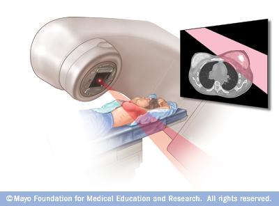 Introduction Radiotherapy in Breast Cancer