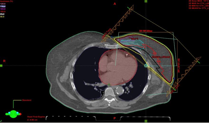 vs. Field-in-Field Intensity Modulated Radiotherapy () 1.