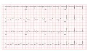 CASE 1 Resting EKG: normal Treadmill stress test CASE 1 Had to be terminated at 5 minutes as he developed headache s and progressive ST depression in the inferior-lateral leads.