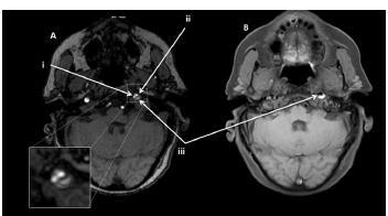 Causes of unilateral headache: Hemorrhage ( SAH/stroke) Temporal arteritis Trigeminal neuralgia Arterial