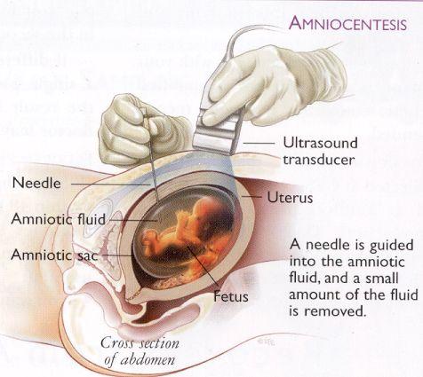 Amniocentesis Process of