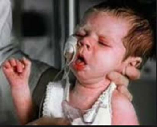 Complications Complications: hypoxia, pneumonia, weight loss, seizures, encephalopathy and death Infants