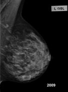 Optimal Compression Breast looks uniform in thickness Reduces dose Reduces unsharpness Subtle density differences seen in the breast more