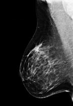 Decreases the ability to differentiate tiny structures on the mammogram,i.e.,