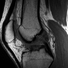 The ACL is located in the center of the knee along with the posterior cruciate ligament (PCL). The ACL is responsible for stabilizing knee rotation that occurs during cutting and pivoting activities.