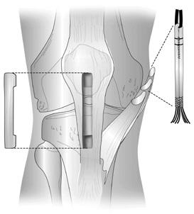Patellar Tendon Graft Hamstring Tendon Graft Figure 2: Donor sites for patellar tendon and hamstring tendon grafts that measures the laxity or looseness in the uninjured knee compared to the injured