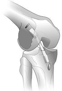 Consequences of an ACL Injury When treating an ACL injury, the key is controlling the instability of the knee.