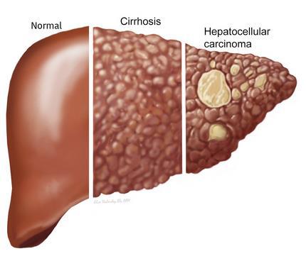 7 million CHB treated worldwide Hepatocellular Carcinoma (HCC) : 2 nd cause