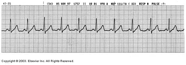 Normal EKG Rhythm & Values Normal Values (Adult) Rate