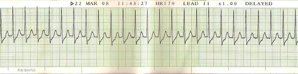 Supraventricular Tachycardia (SVT) Why? Very Rapid Rate (150-250) P wave may be buried in preceding T wave PRI difficult to measure but may be between 0.12 and 0.