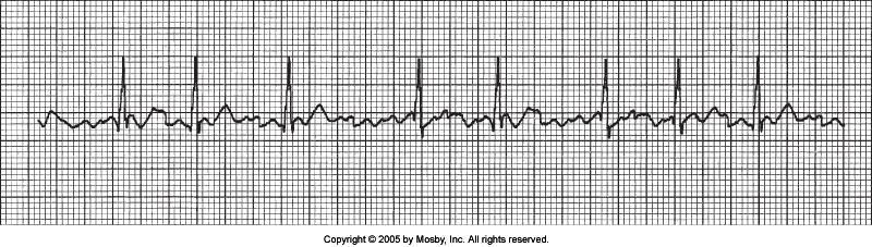 Atrial Fibrillation Why? No identifiable p-waves Chaotic irregular baseline QRS distinguishable but irregular & <.