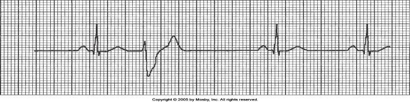 Premature Ventricular Contraction (PVC) Why?