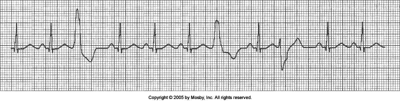P-wave PRI is not measurable Common Causes?